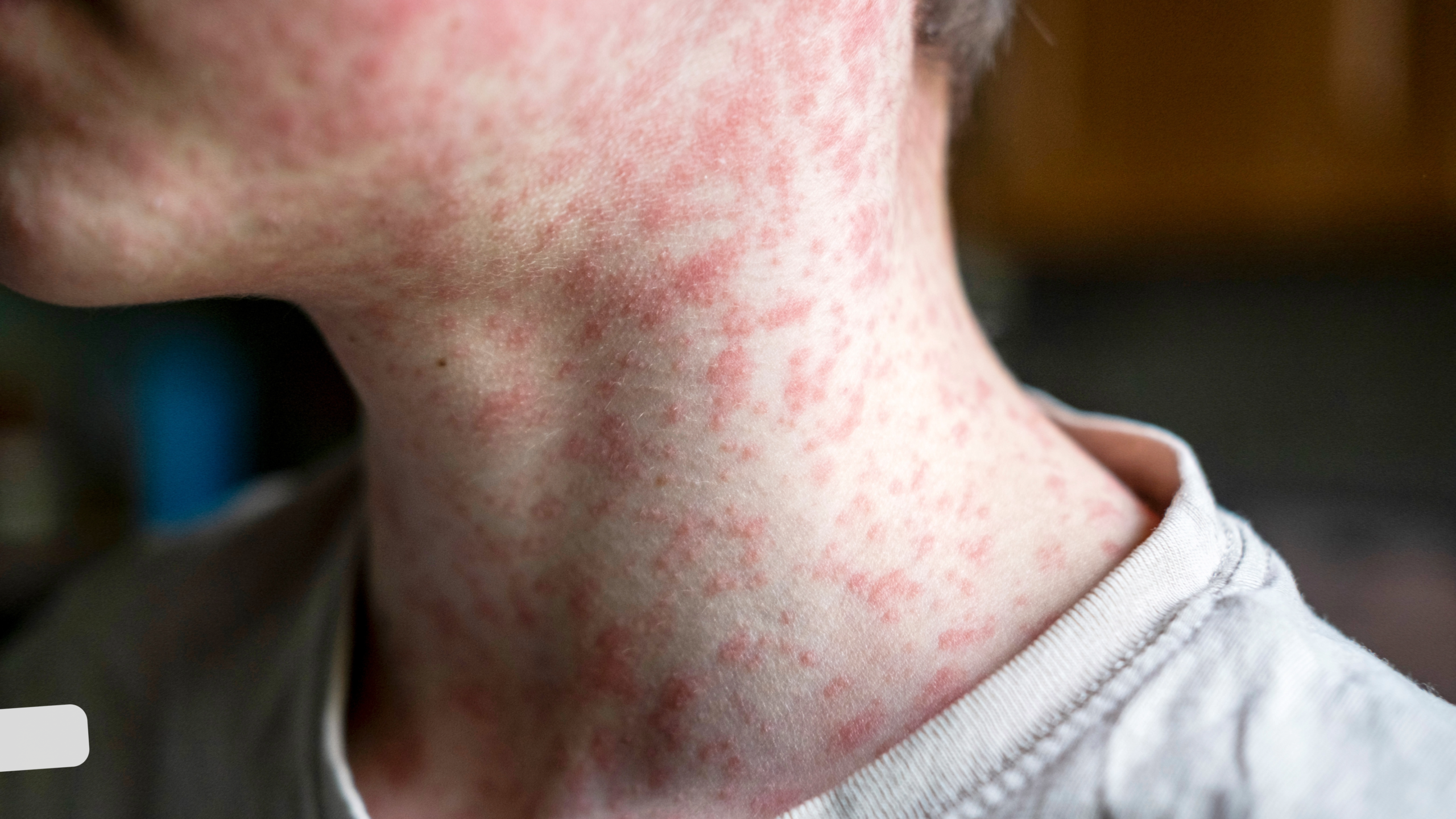 New Jersey Measles Warning as PA Cases Reach 393